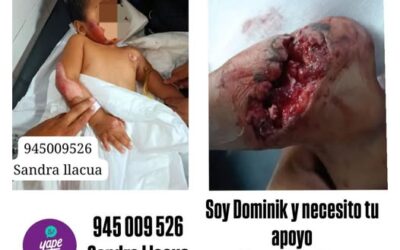 Niño de 2 años resulta gravemente herido tras ser arrastrado por mototaxi